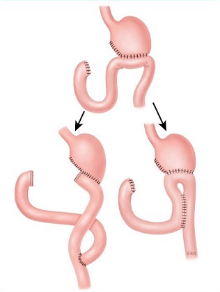 Surgical Management of Afferent Limb Obstruction