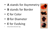 ABCDE of Melanoma