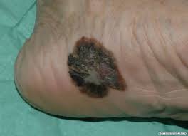 Acral Melanoma