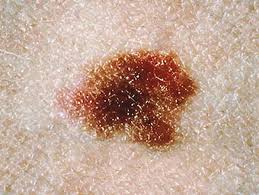 Dysplastic Nevus