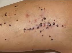 Melanoma In-Transit Disease