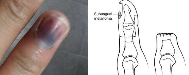 Subungal Melanoma and Amputation