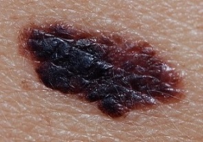 Superficial Spreading Melanoma