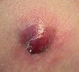 Ulcerated Nodular Melanoma