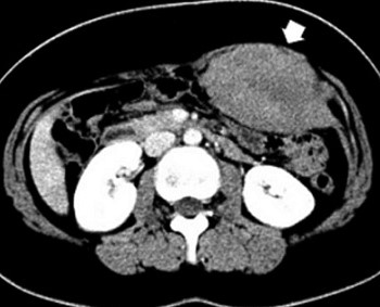 Abdominal Wall Desmoid Tumor