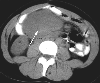 IntraAbdominal Desmoid Tumor