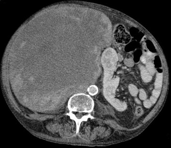 Retroperitoneal Sarcoma