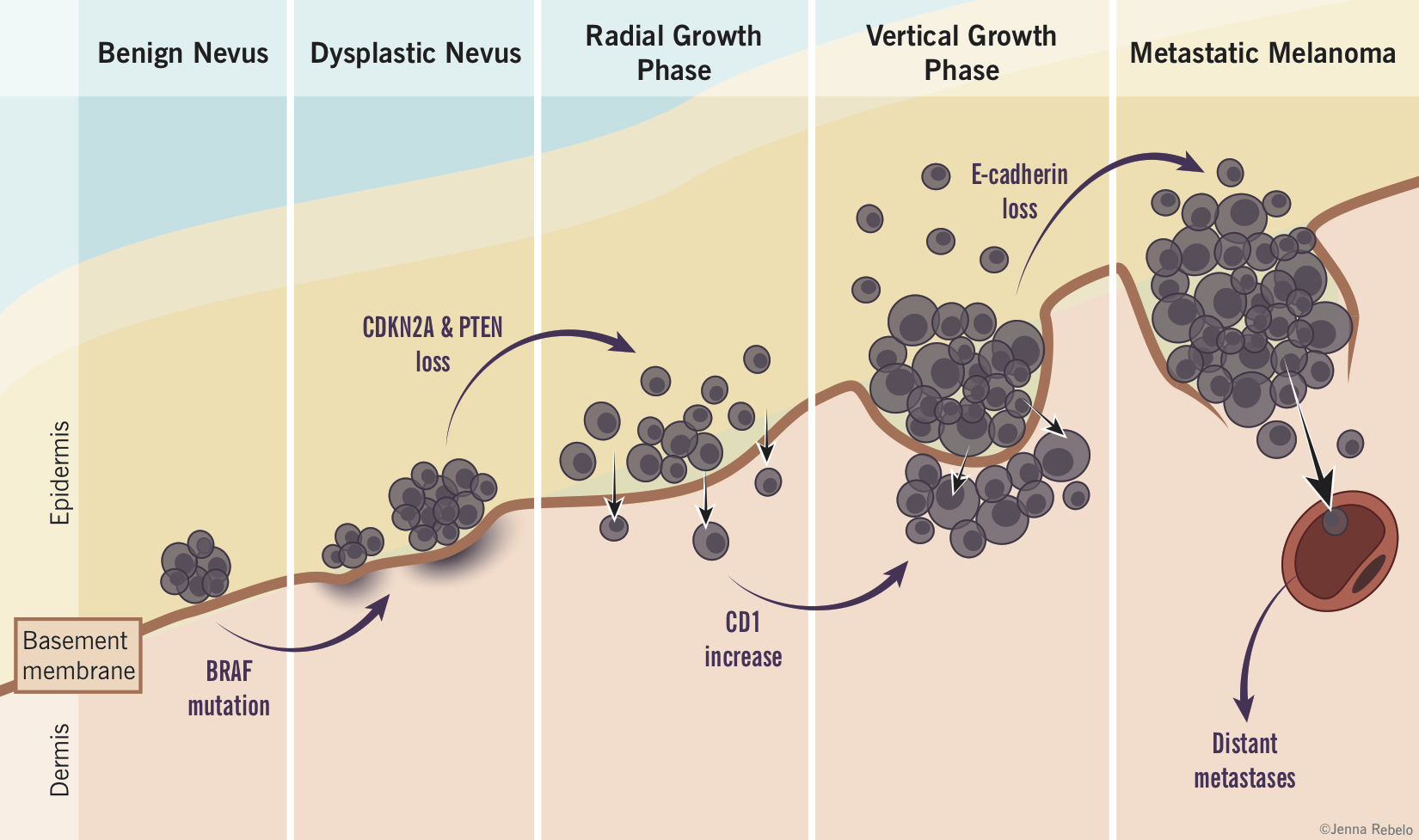 Nevus-to-Melanoma Progression