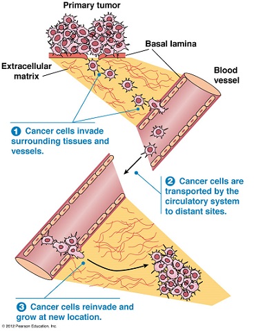 Putative Steps in Metastasis