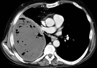 Right Empyema _ CT Scan