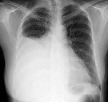 Right Pleural Effusion - CXR