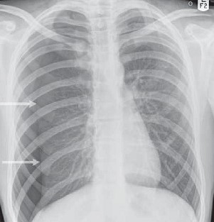 Spontaneous Pneumothorax - CXR