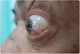 Exophthalmos in Graves' Disease