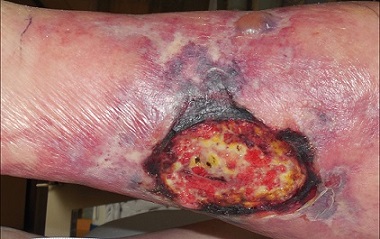 Calciphylaxis