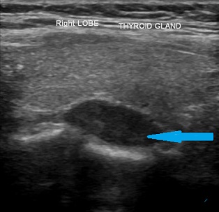 Parathyroid Adenoma - Neck Ultrasound