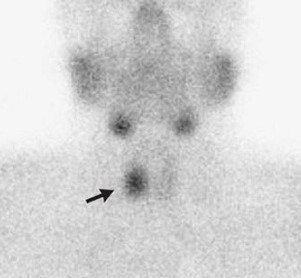 Parathyroid Adenoma - Sestamibi scan