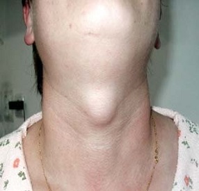 Thyroglossal Duct Cyst