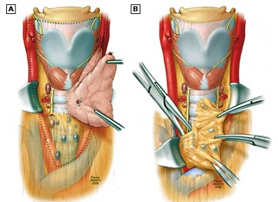 Central Neck Dissection