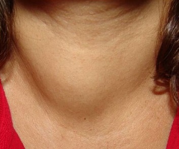 Palpable Right Thyroid Nodule