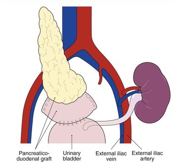 Pancreas Bladder Drainage