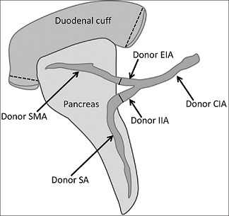 Donor Pancreas Arterial Reconstruction