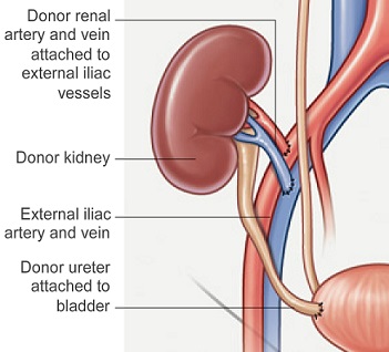 Kidney Transplant