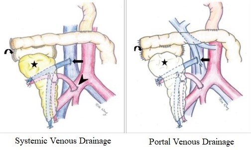 Pancreas Portal vs Systemic Drainage