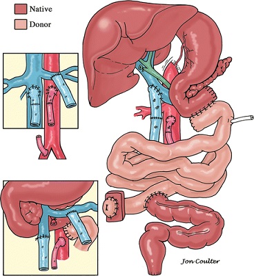 Isolated Small Intestine Transplant