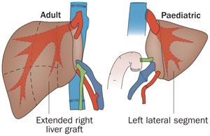 Liver Transplant Split Liver Technique