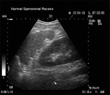 FAST - Normal LUQ Scan