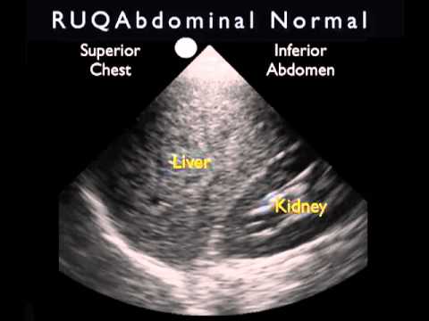 FAST - Normal RUQ Scan