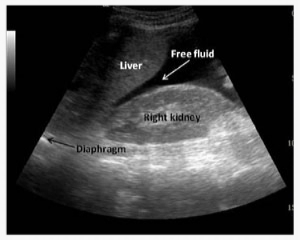 FAST - Positive RUQ Scan