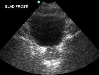 FAST - Normal Pelvis Scan