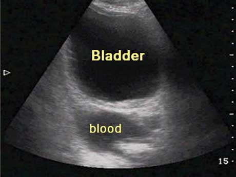 FAST - Positive Pelvis Scan