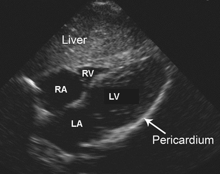 FAST - Normal Subxiphoid Scan