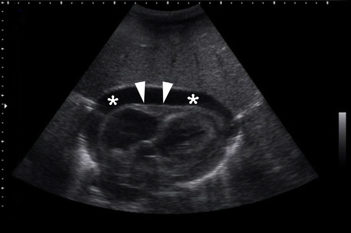 FAST - Cardiac Tamponade