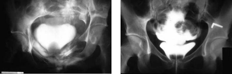 Intraperitoneal and Extraperitoneal Bladder Rupture