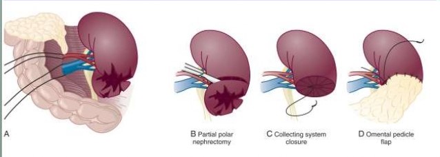 Partial Nephrectomy