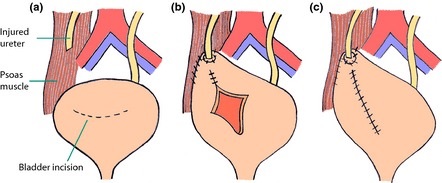 Psoas Hitch