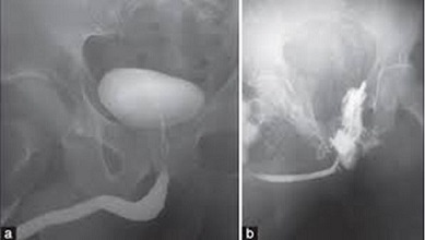 Retrograde Urethrogram