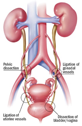 Common Sites of Ureteral Injury