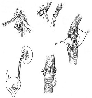 Ureteroureterostomy