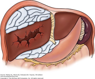 Hepatic Packing