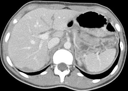 Grade I Liver Injury