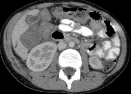 Grade II Liver Injury