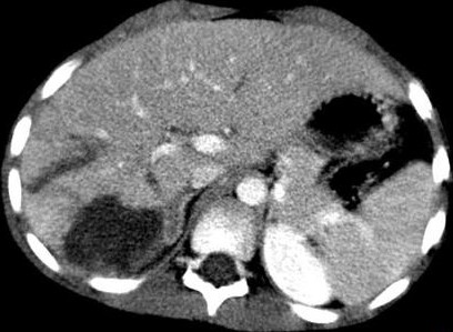 Grade III Liver Injury