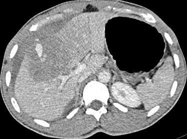 Grade IV Liver Injury