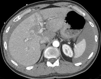 Grade V Liver Injury