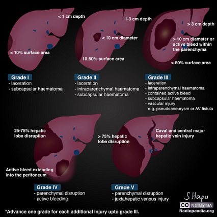 Liver Trauma Grading