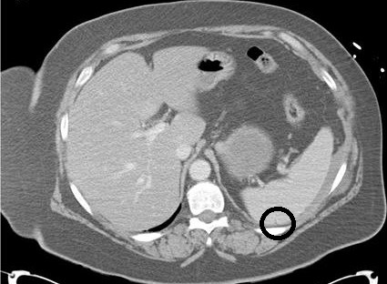 Grade I Splenic Injury